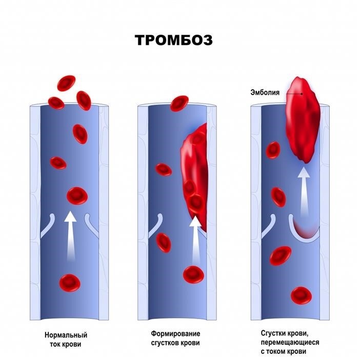 Тромбоз.jpg